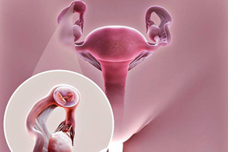 Яичниковая Беременность Фото